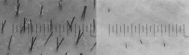 antes y después depilado definitivo laser paraguay velours