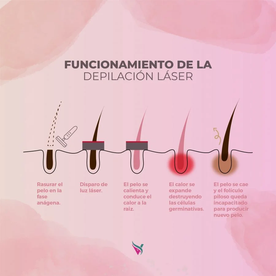 funcionamiento de la depilacion laser soprano titanium en paraguay